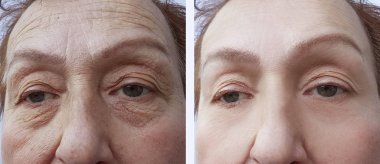 Yaşlı kadın öncesi ve sonrası yordamları yüz