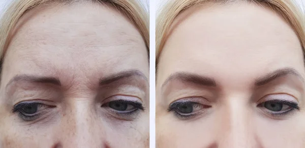 Mulher Enrugamento Rosto Antes Depois Dos Procedimentos Pigmentação — Fotografia de Stock