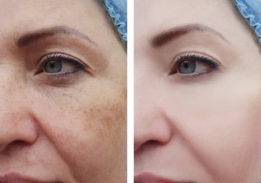yüz kırışıklık kadın öncesi ve sonrası yordamları, pigmentasyon