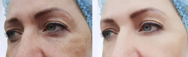 手术前后的面部皱纹妇女 色素沉着 — 图库照片
