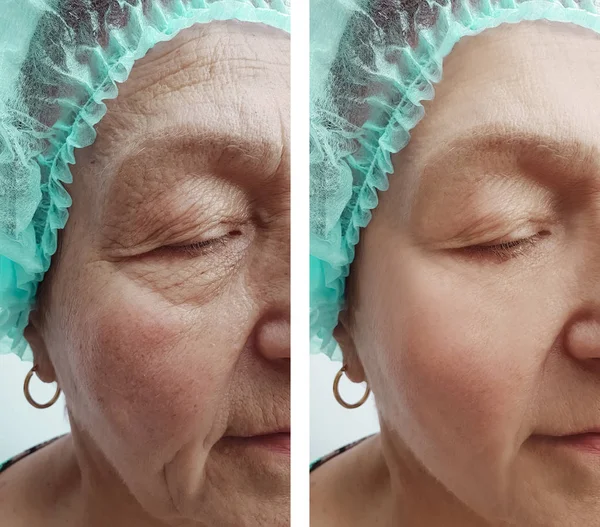 Elderly Woman Wrinkles Face Procedures Effect — Stock Photo, Image