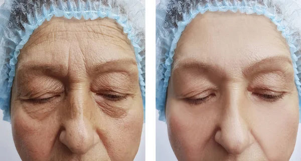 Elderly Woman Wrinkles Face Procedures Effect — Stock Photo, Image