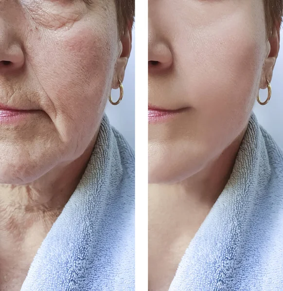 Wanita Tua Keriput Wajah Sebelum Dan Setelah Prosedur Efek — Stok Foto