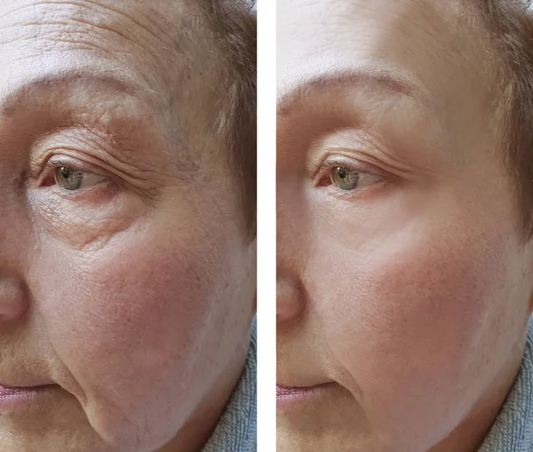 老年妇女手术前后面部皱纹 — 图库照片