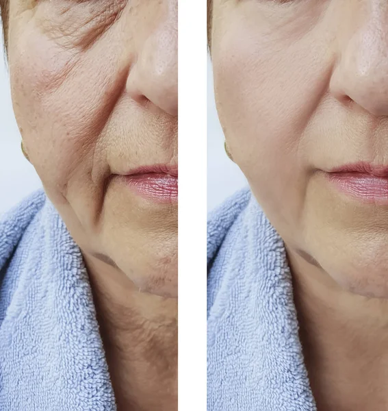 Πρόσωπό Της Μια Ηλικιωμένη Γυναίκα Πριν Και Μετά Τις Θεραπείες — Φωτογραφία Αρχείου