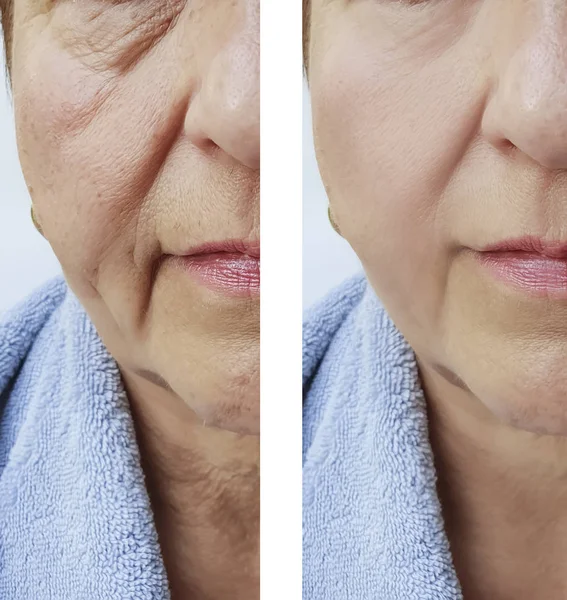 Rostro Una Mujer Mayor Antes Después Los Tratamientos — Foto de Stock