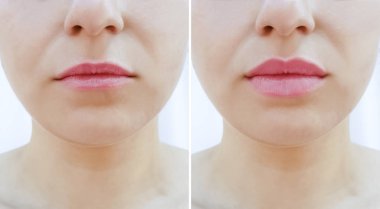 kız dudakları büyütmeden önce ve sonra