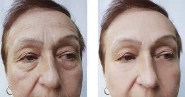 yüz kırışıklıkları yaşlı kadın öncesi ve sonrası yordamları