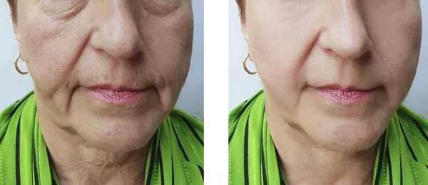 Yüz Kırışıklıkları Yaşlı Kadın Öncesi Sonrası Yordamları — Stok fotoğraf