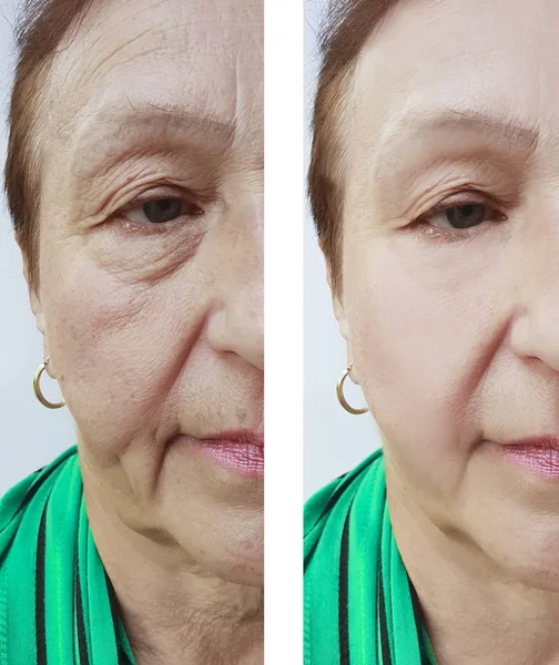 Face Wrinkles Elderly Woman Procedures — Stock Photo, Image