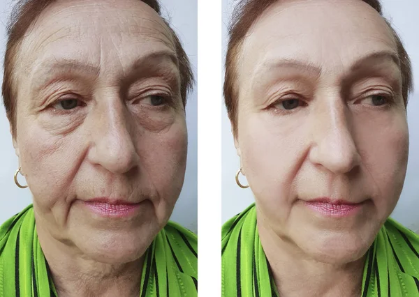 面部皱纹老年妇女的手术前后 — 图库照片