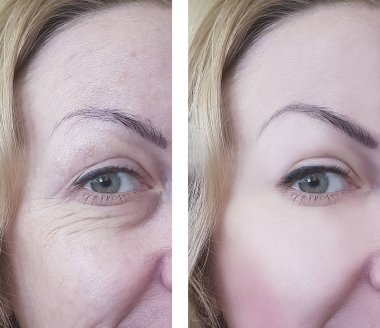 kadın göz kırışıklıkları öncesi ve tedavi sonrası