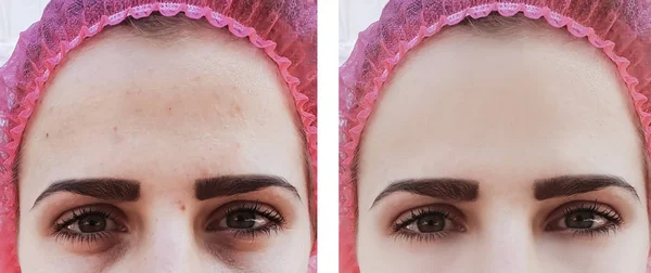 Weibliche Augenfalten Vor Und Nach Behandlungen — Stockfoto
