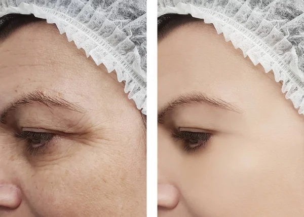 Arrugas Mujer Cara Antes Después Los Tratamientos — Foto de Stock