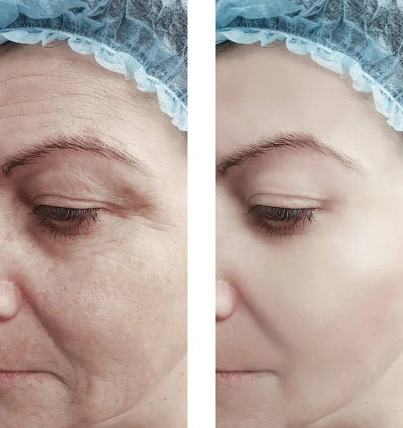 Woman Wrinkles Face Treatments — Stock Photo, Image