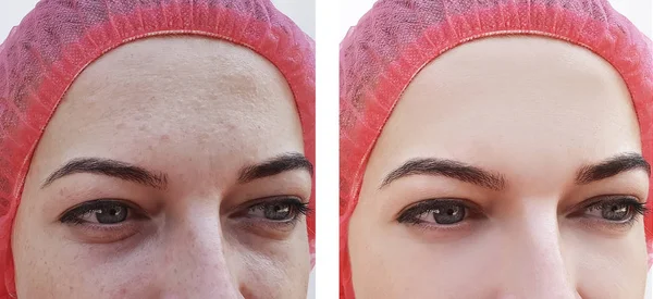 Gesicht Frau Augenfalten Vor Und Nach Eingriffen — Stockfoto