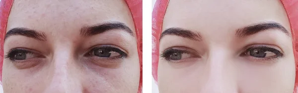 Cara Mujer Arrugas Los Ojos Antes Después Los Procedimientos —  Fotos de Stock