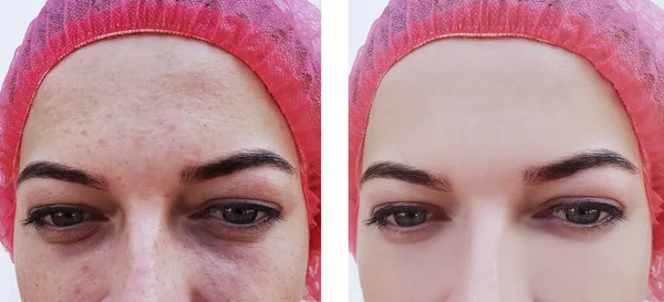 face woman, wrinkles of eyes before and after procedures