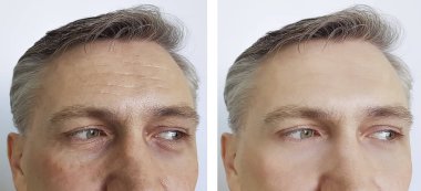 Erkek kırışıklıkları öncesi ve tedavi sonrası