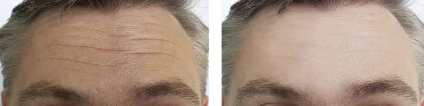 Male Forehead Wrinkles Procedures — Stock Photo, Image