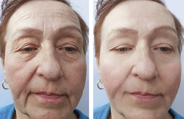 Face Old Woman Wrinkles Procedures — Stock Photo, Image