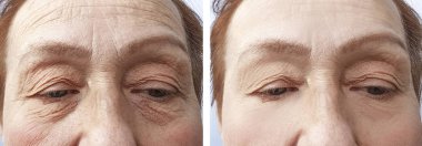 Yaşlı bir kadının yüz kırışıklıklar önce ve sonra yordamları