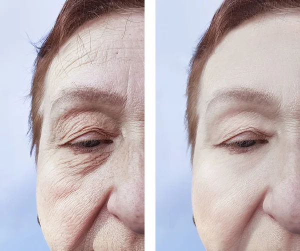 Rosto Uma Mulher Velha Rugas Antes Depois Procedimentos — Fotografia de Stock