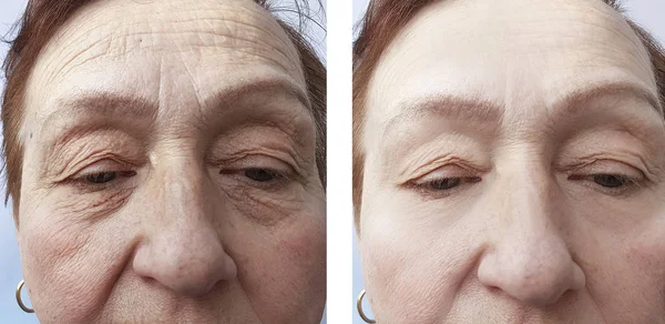face of an old woman wrinkles before and after procedures