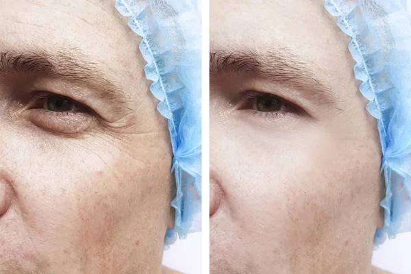 Wrinkles Man Face Procedures — Stock Photo, Image
