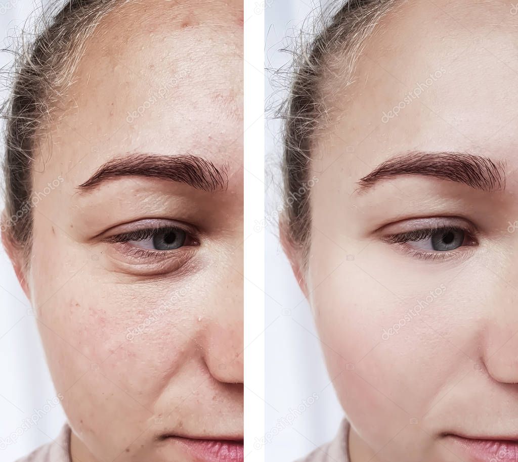 girl wrinkles eyes before and after procedures