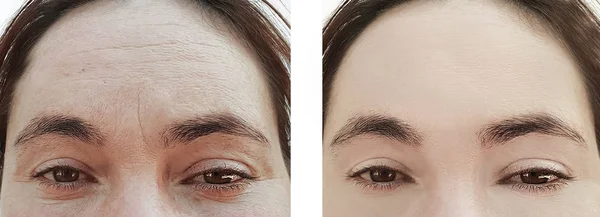 Wanita Keriput Wajah Sebelum Dan Sesudah Pengobatan — Stok Foto