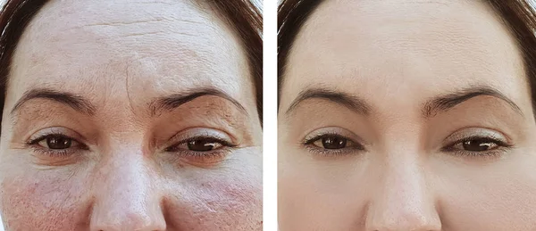 Γυναίκα Πρόσωπο Ρυτίδες Πριν Και Μετά Θεραπεία — Φωτογραφία Αρχείου