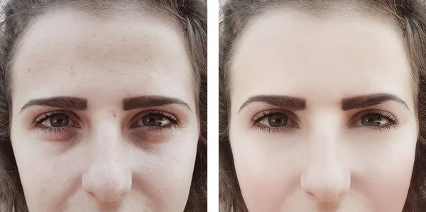 Chica Arrugas Ojos Antes Después Procedimientos Bolsas — Foto de Stock