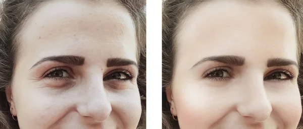 Kız Kırışıklıklar Gözleri Önce Sonra Yordamlar Çanta — Stok fotoğraf