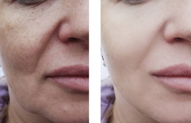 kadın kırışıklıkları yüz öncesi ve tedavi sonrası