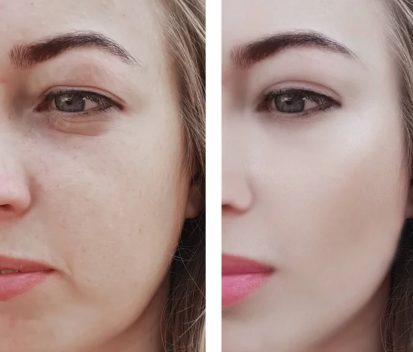 girl wrinkles eyes before and after procedures, bags, bloating