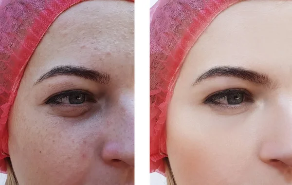 Menina Rugas Olhos Antes Depois Procedimentos — Fotografia de Stock