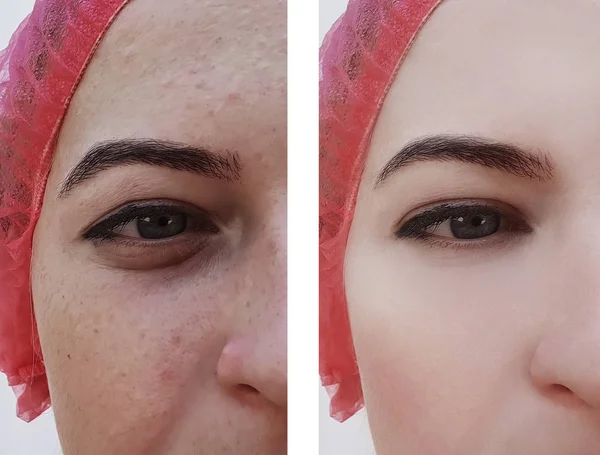 Menina Rugas Olhos Antes Depois Procedimentos — Fotografia de Stock