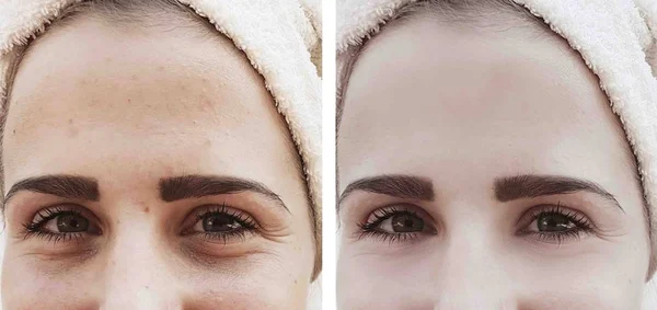 girl wrinkles eyes before and after procedures, bloating