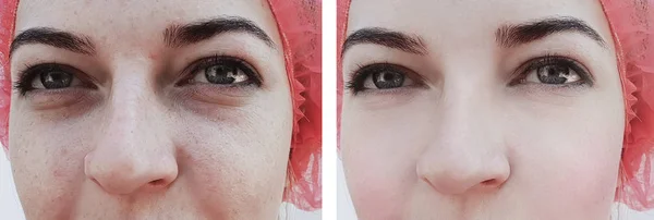 Gadis Keriput Mata Sebelum Dan Setelah Prosedur Kembung Tas — Stok Foto