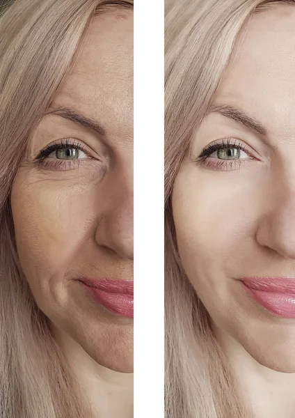 Arrugas Mujer Cara Antes Después Los Procedimientos —  Fotos de Stock