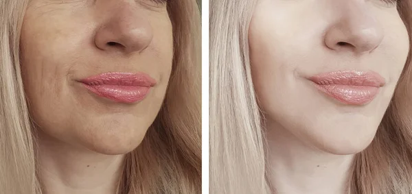 Arrugas Mujer Cara Antes Después Los Procedimientos —  Fotos de Stock
