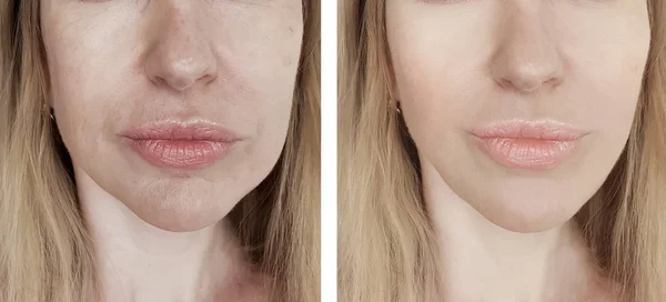 皱纹妇女之前和之后的程序 — 图库照片