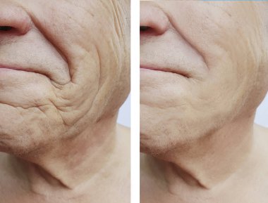 Erkek kırışıklıkları öncesi ve tedavi sonrası