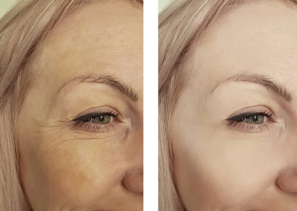 Female Eye Wrinkles Treatments — Stock Photo, Image