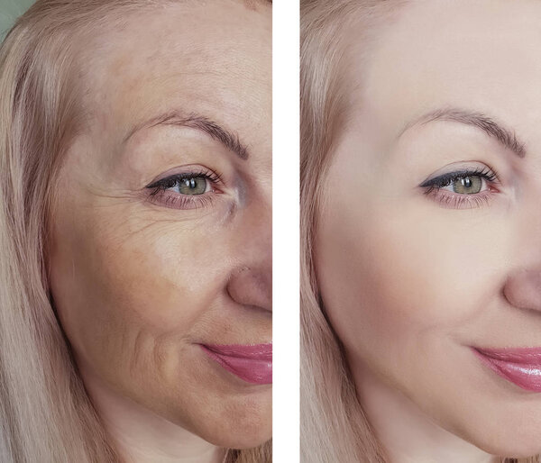 female eye wrinkles before and after treatments