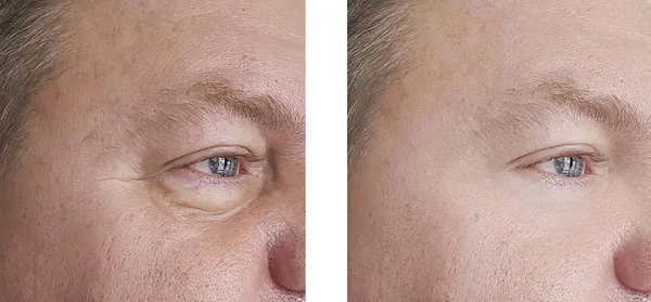 adam kırışıklıkları önce ve sonra yordamı