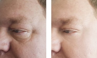 adam kırışıklıkları önce ve sonra yordamı