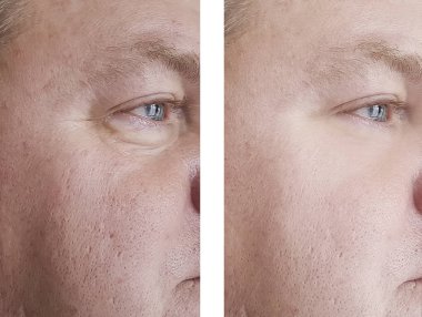 adam kırışıklıkları önce ve sonra yordamı