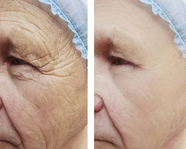 Old Man Wrinkles Procedures — Stock Photo, Image